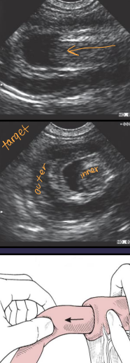 <ul><li><p><span style="color: rgb(136, 136, 136);"><strong>Et:</strong></span><strong> </strong>Overlap of junctions of fixed &amp; mobile bowel</p></li></ul><ul><li><p><strong>Intussusceptum</strong> = proximal loop; <strong>Intussuscipiens</strong> = distal loop</p></li><li><p><strong>Young:</strong> parasites, FB, viral enteritis</p></li><li><p><strong>Old: </strong>neoplasia, infiltrative bowel dz, FB</p></li></ul><ul><li><p><span style="color: rgb(136, 136, 136);"><strong>Cs:</strong></span> diarrhea, anorexia, <strong>weight loss, pain</strong></p></li><li><p><span style="color: rgb(136, 136, 136);"><strong>Dt: </strong></span>palpable tubular mass, radiographs (ileus),US</p></li><li><p><span style="color: rgb(136, 136, 136);"><strong>Tx: </strong></span>manual reduction (no adhesions), R&amp;A (devitalized), <strong>SURGERY</strong></p></li></ul><p></p>