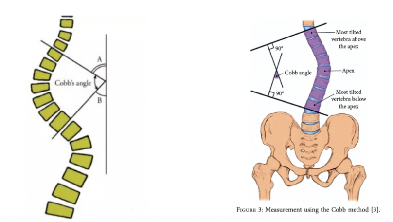 <p><span style="background-color: transparent;">Two vertebrae are used as landmarks for measuring the Cobb angle - the most tilted vertebra at the top of the spinal curve, and the most titled vertebra at the bootm of the spinal curve. The first line of the angle runs along the top of the high vertebra, and the other runs along the bottom of the low vertebrae, the Cobb angle is measured where these two lines intersect (image 1). This angle can also be determined using the intersection of the tangents of these two lines (image 2)</span></p>
