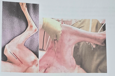 femoral nerve block on inner thigh
