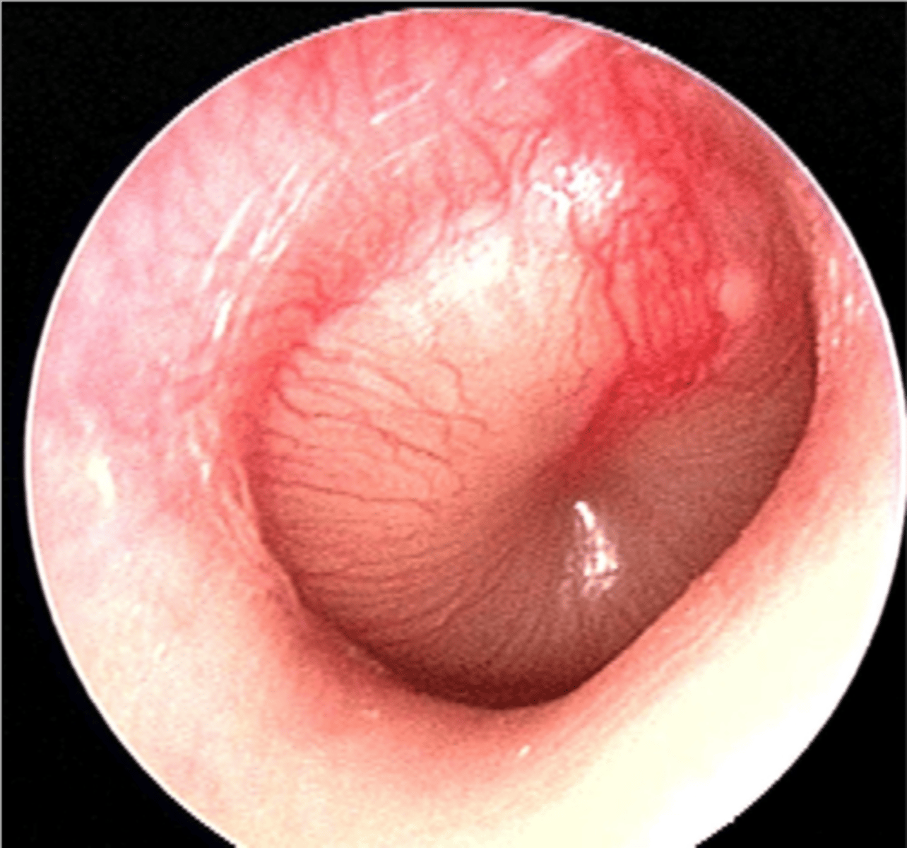 <p>INFECTION of middle ear</p><p>TM bulging</p><p>Pain/pulling ear</p><p>Conductive HL dt purulent material</p><p>Erythema</p>