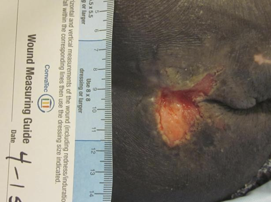 <ul><li><p><strong><u>Full thickness skin loss</u></strong></p></li><li><p>Adipose Tissue is visible</p></li><li><p>Wound Base:</p><ul><li><p>Granulation Tissue</p></li><li><p>Sough and/or Eschar</p></li></ul></li><li><p>Wound Edge:</p><ul><li><p>Epibole</p></li><li><p>Undermining and Tunneling may occur</p></li></ul></li></ul><p></p>