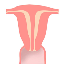 <p>– Two partially or completely separate endometrium form.</p><p class="p1">– The uterus is normally shaped</p><p class="p1">– <strong><em>Most common congenital uterine anomaly causing infertility.</em></strong></p>