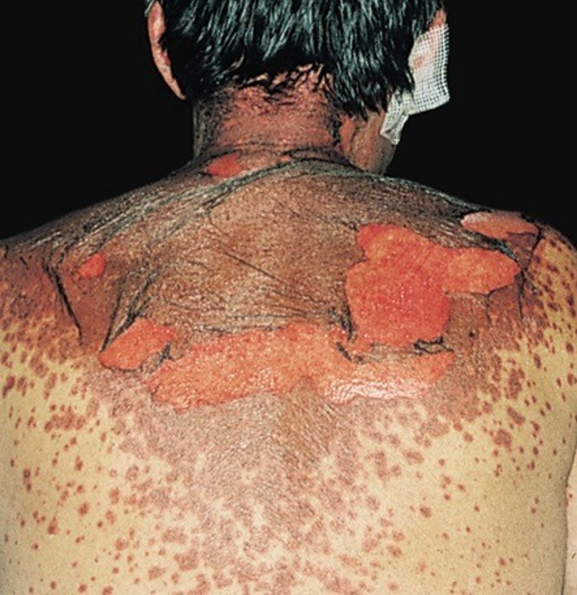 <p>- fever</p><p>- massive skin damage/peeling off</p><p>- internal organ damage</p><p>- sepsis</p><p>DISCONTINUE THE MEDICATION IMMEDIATLY IF RASHING OCCURS</p>