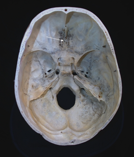 cribriform plate 