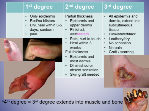 Use preparation H for when you get burned (its a hemmeroid cream); pain is good thing because it means the nerve endings are still intact; once infection reaches bone, doctors are unable to do anything to treat other than amputation; burn victims suspectible to infections becasue skin is exposed