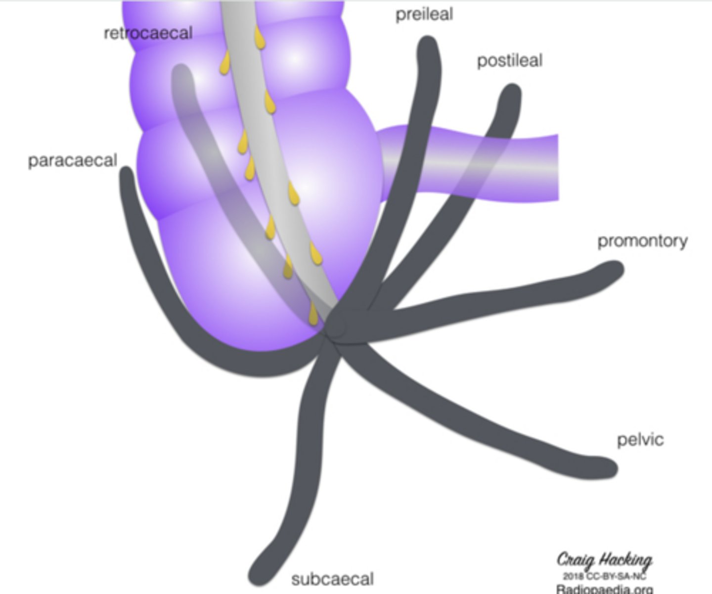 <p>Pelvic</p><p>Retrocecal</p><p>Preileal</p><p>Subcecal</p><p>Subileal</p><p>explaining variable appendicitis pain.</p><p>Think Please Remember People Study Seriously</p>