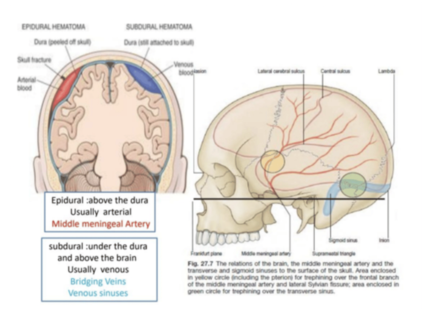 <p>Middle meningeal artery</p>