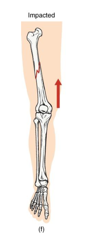<p><strong>Definition: One fragment is driven into another within the same bone</strong></p><p><strong>Mechanism</strong>: Axial loading (ex: landing hard on extended arm/leg)</p><p><strong>Clinical note: Bone ends jammed together;</strong> limb may apper shortened</p><p><strong>Key concept:</strong> common in falls - the bone compresses itself</p>