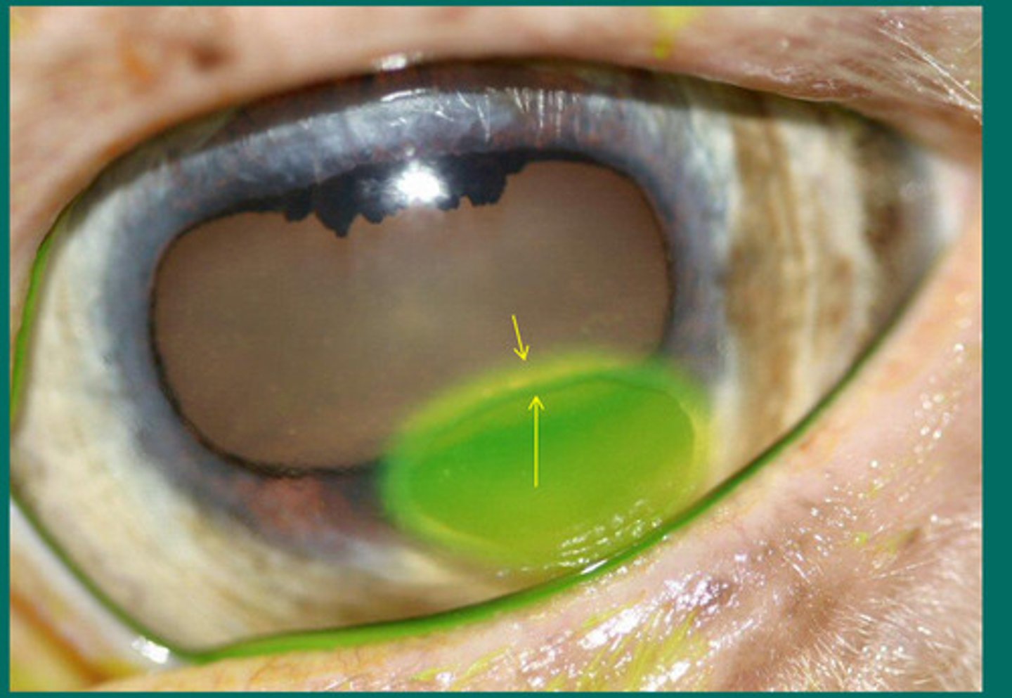 <p>This ulcer has been healing for 8 weeks and there is loose epithelium. What should you do?</p>