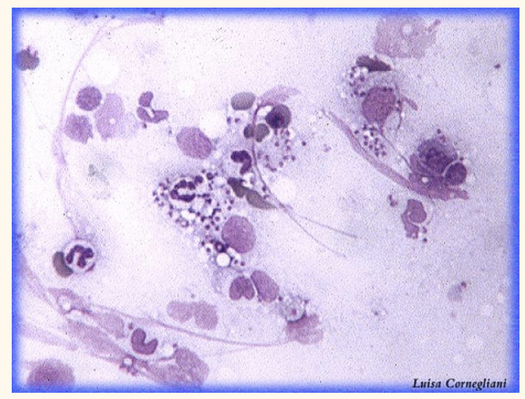 <p>Lymph node aspirate; what’s going on here?</p>