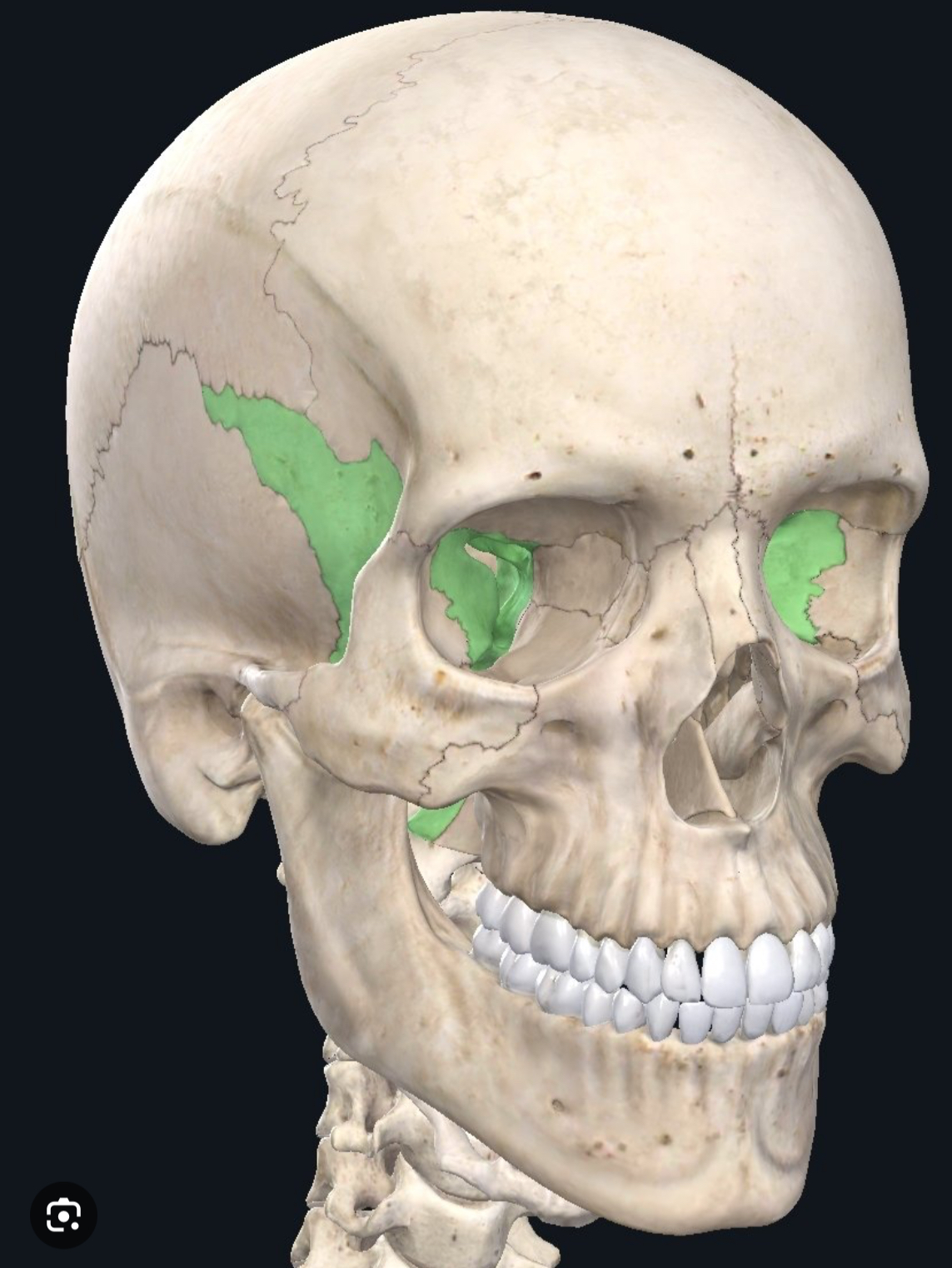 <p>Sphenoid bone </p>