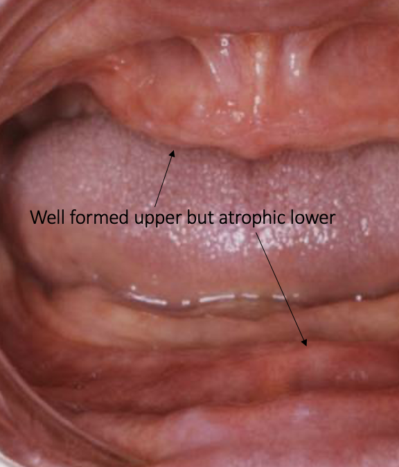 <ul><li><p>the magnitude of alveolar resorption is approx. x4 greater in the mandible than the maxilla</p></li></ul><p></p>