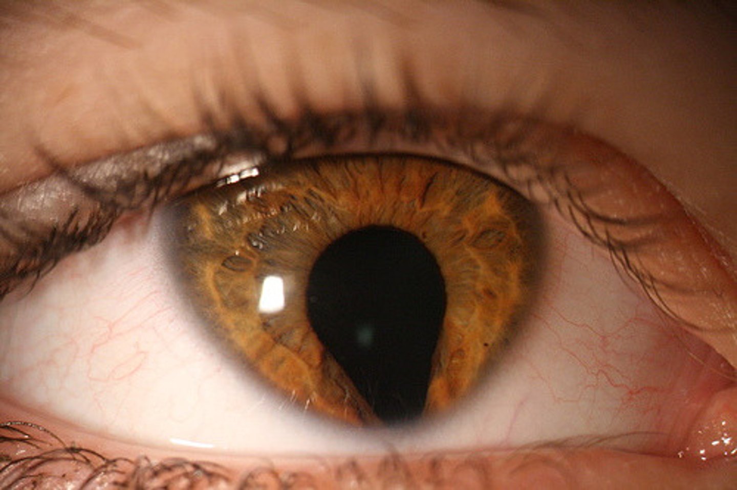<p>coloboma = absence/defect of ocular tissue</p><p>CHARGE:</p><p>Coloboma</p><p>Heart anomalies</p><p>Atresia of choanae</p><p>GU abnormalities</p><p>Ear anomalies</p>