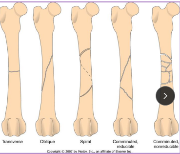 <p>Describe the Fracture</p>