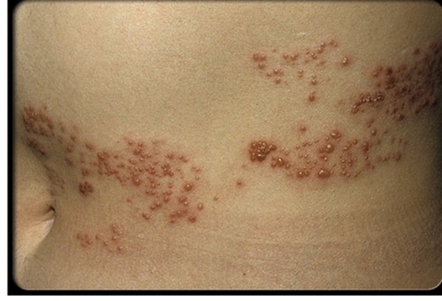 <p>Herpes zoster is a disease caused by reactivation of the varicella zoster virus that usually presents with a rash in a very specific dermatomal distribution. Also known as shingles</p>