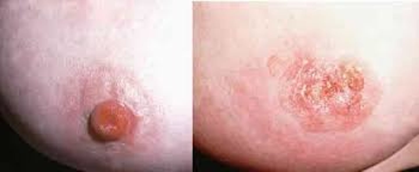 <p>Paget disease:</p><p>- Condition where tumor cells originating from DCIS or invasive carcinoma replace the epithelial cells of the epidermis of the nipple </p><p>Metastasis:</p><p>- Can do it anywhere -&gt; most commonly to lungs, skeleton and liver </p>