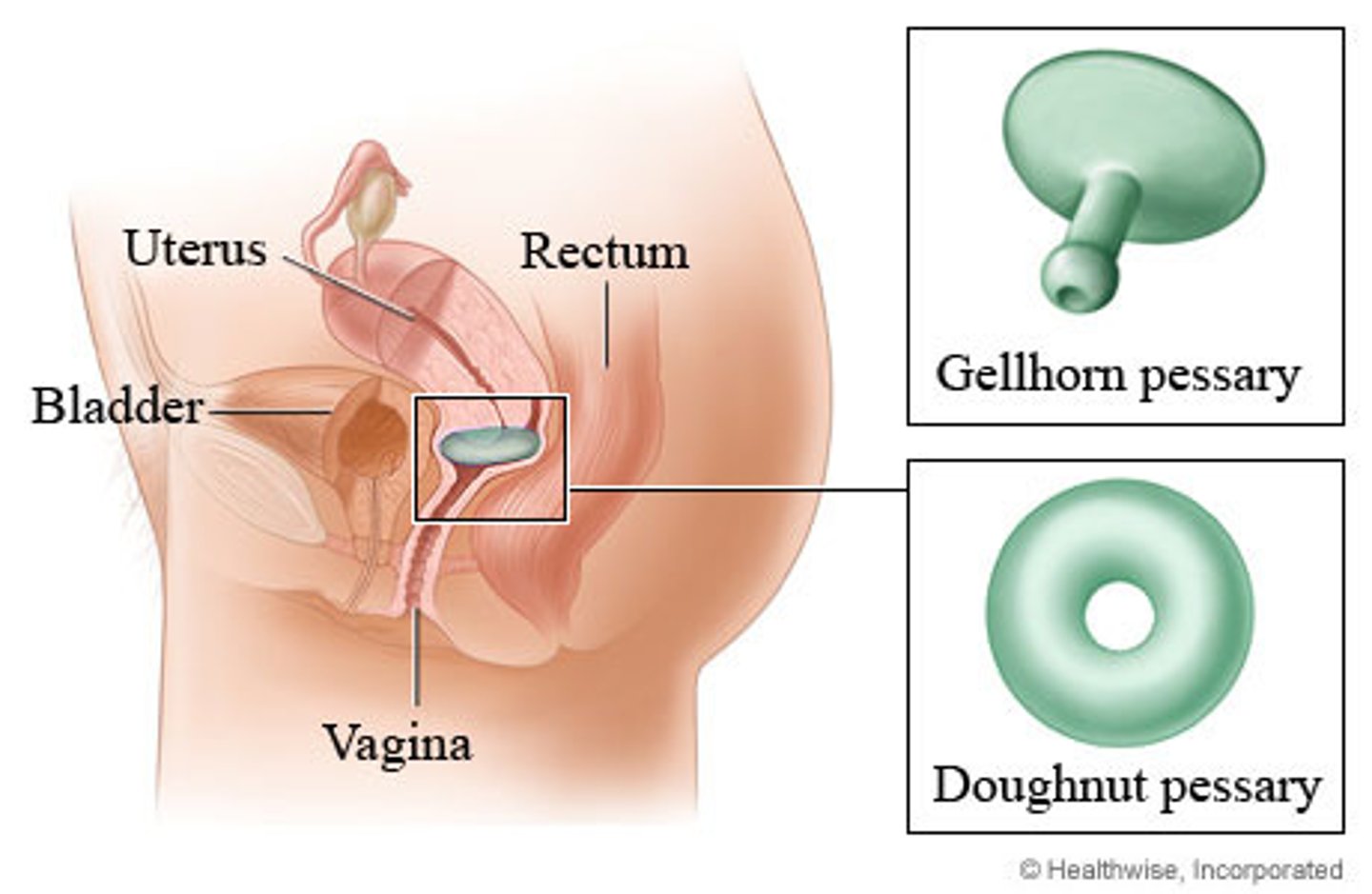 <p>descent of pelvic organs such as the (uterus, bladder, rectum) through the vaginal canal due to weakening of pelvic floor muscles and ligaments</p><p>- typically caused by childbirth, aging, chronic increased intra-abdominal pressure (constipation, obesity)</p>