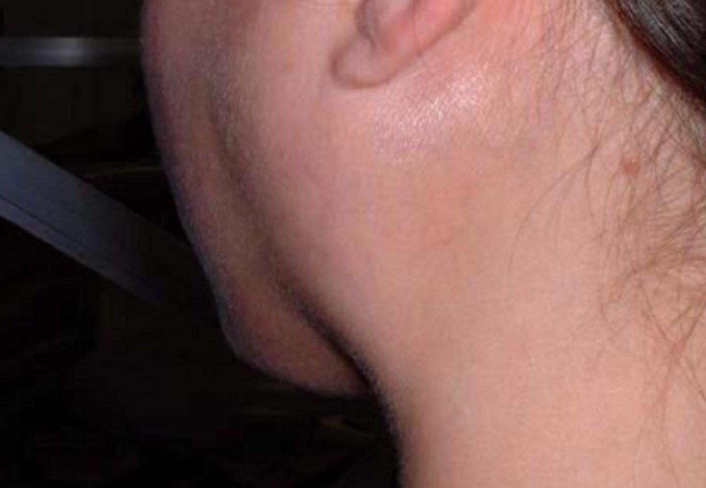 <p>bacterial sialadenitis</p>