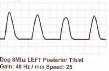 <p>Describe the upstroke, amplitude, and flow reversal of the following waveform </p>
