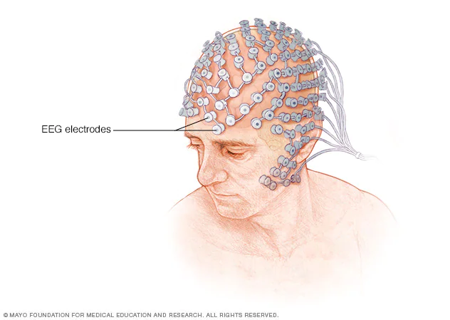 <p>EEG (Electroencephalogram)</p>