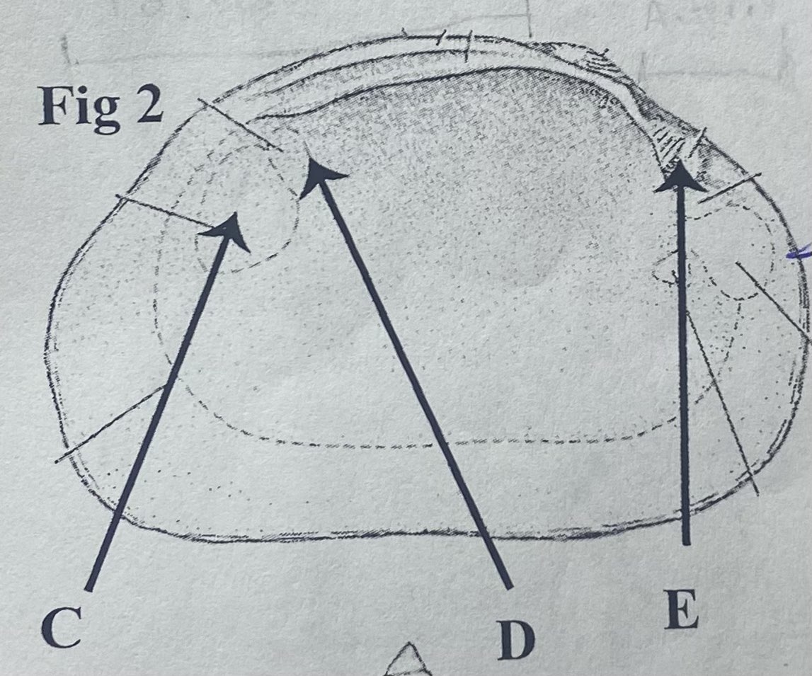 The scar indicated by arrow D is