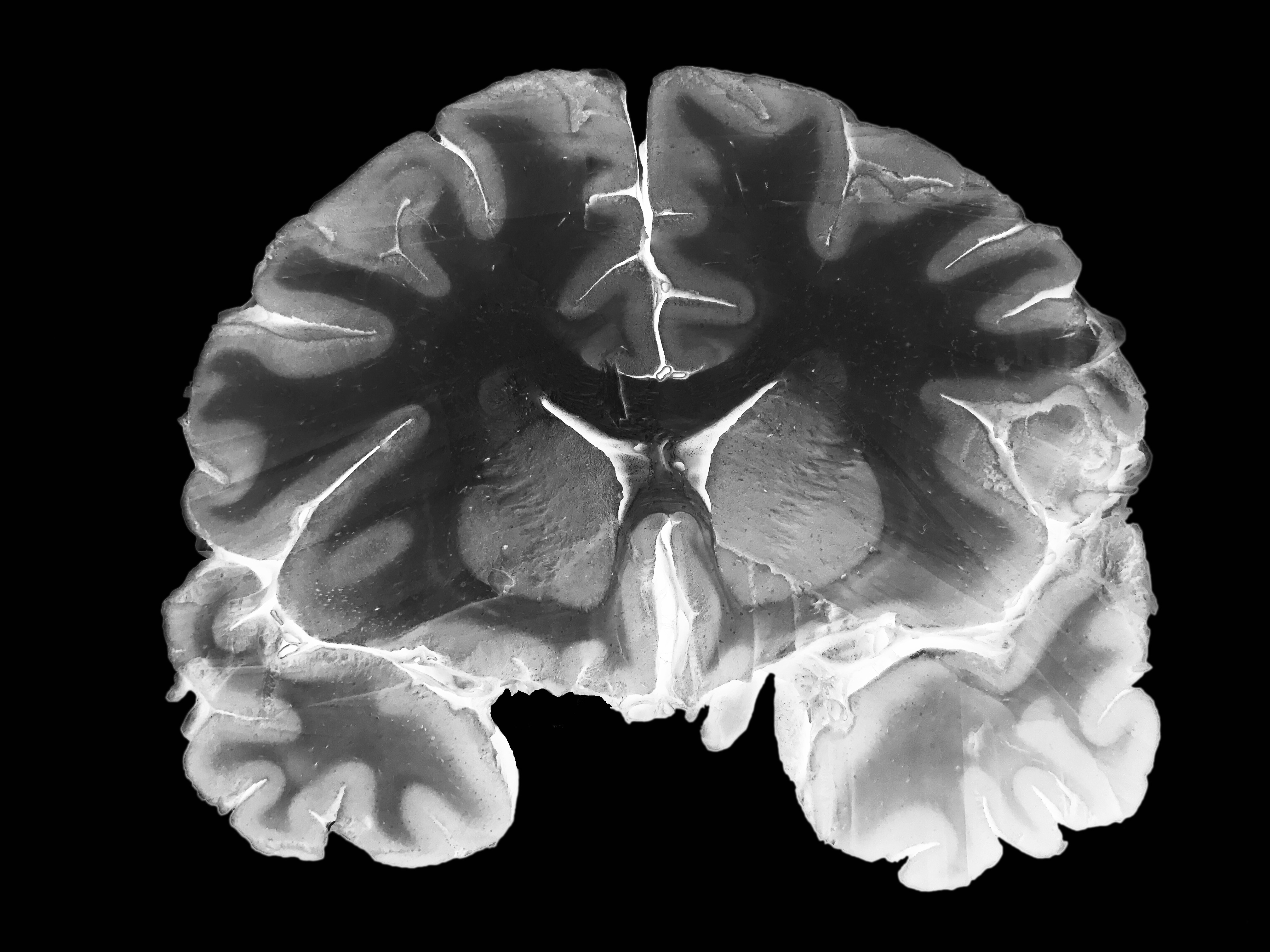 Normal Brain