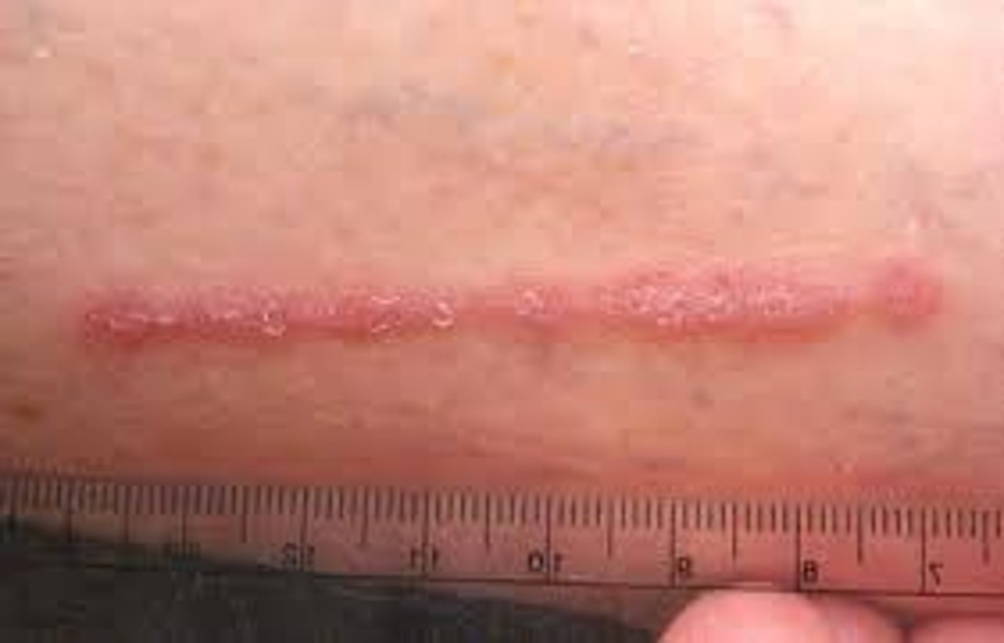 <p>A mark on the skin; may indicate an injury or damage that changes the structure of tissues or organs. Can be as simple as a freckle or as dangerous as a skin cancer.</p>