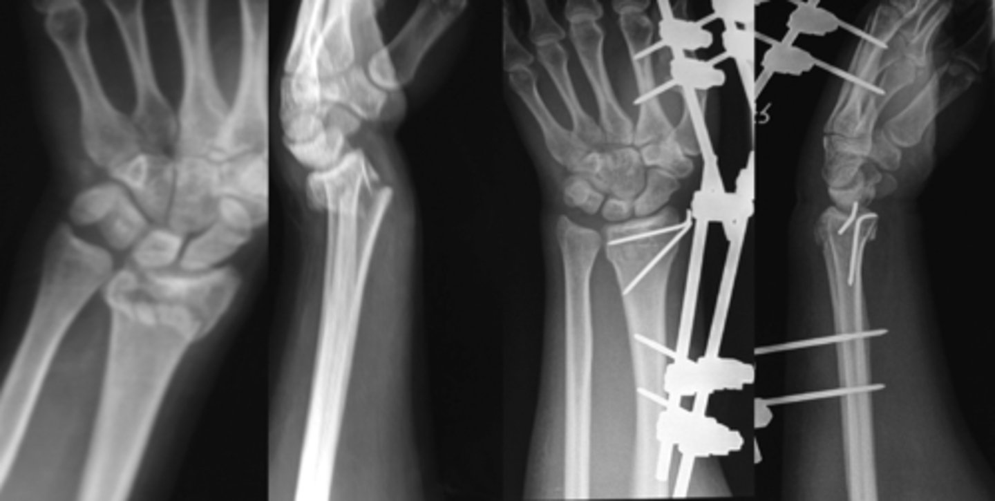 <p>supraconfylar fracture of humerus</p>