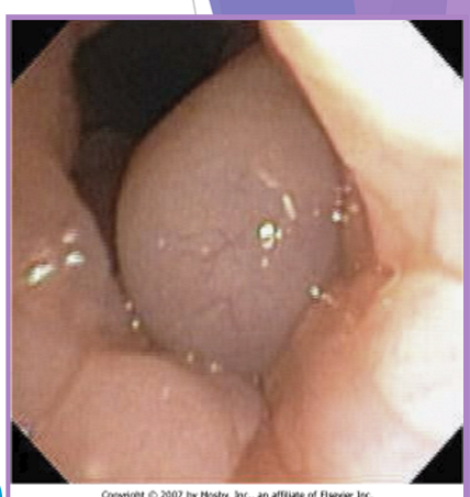 <p>BOAS everted laryngeal saccules </p>