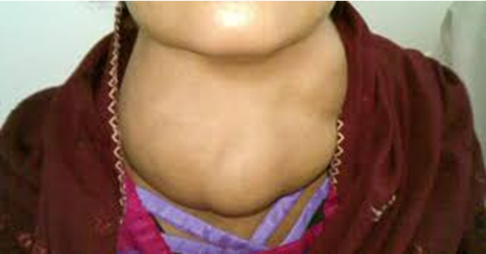 <p>Enlarged thyroid</p><p>Lack of iodide (mainly iodized salt)</p><p>Essentially you make a bunch of precursor but no iodide to finish the process which leaves it lingering </p>