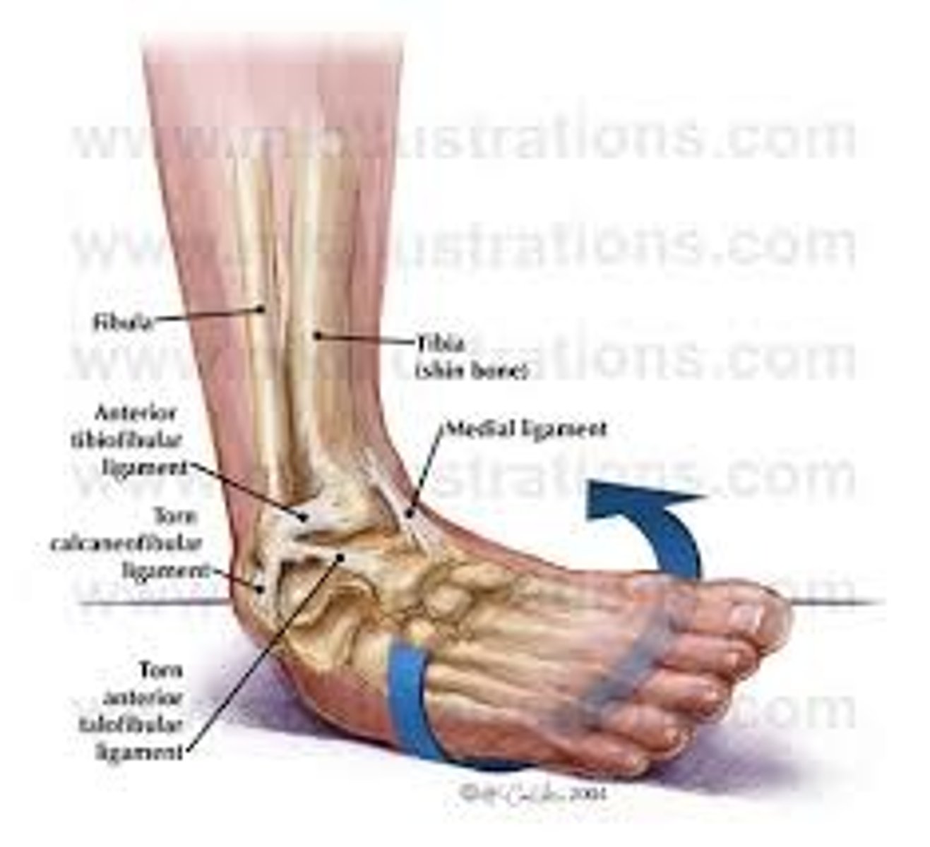<p>injure your ankle by suddenly turning it</p>