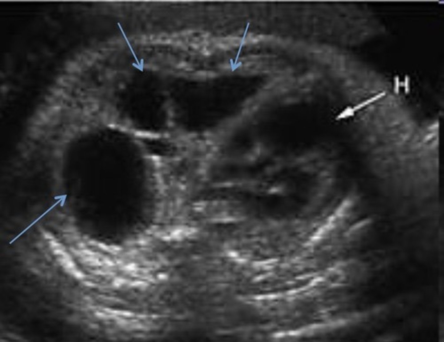 <p>Most common CPAM type</p><p>Large Cysts</p><p>Good prognosis</p>