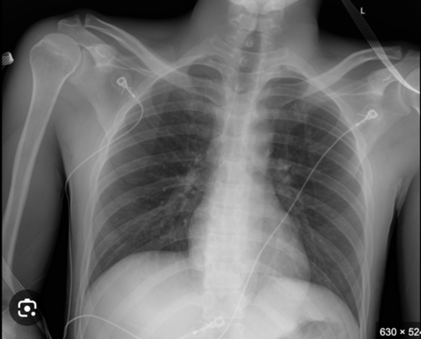 <p>CXR where patient has to be able to stand up</p>