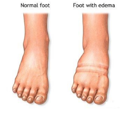 <p>the accumulation of fluid in the interstitial fluid</p><ul><li><p>if lymphatic drainage is compromised, fluid will accumulate</p></li><li><p>if balance of pressures between capillary hydrostatic and osmotic pressures may favor movement of fluid into interstitial space:</p><ul><li><p>increased capillary pressure (typically due to increased venous pressure)</p></li><li><p>decreased plasma protein concentration (e.g. liver failure)</p></li><li><p>increased interstitial fluid protein (leakage, tissue damage)&nbsp;</p></li></ul></li></ul><p></p>