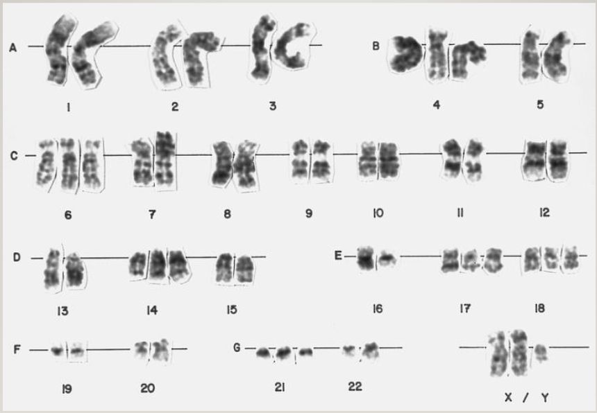 HAutosomal recesstiThis karyotype have trisomy in several chromosomes