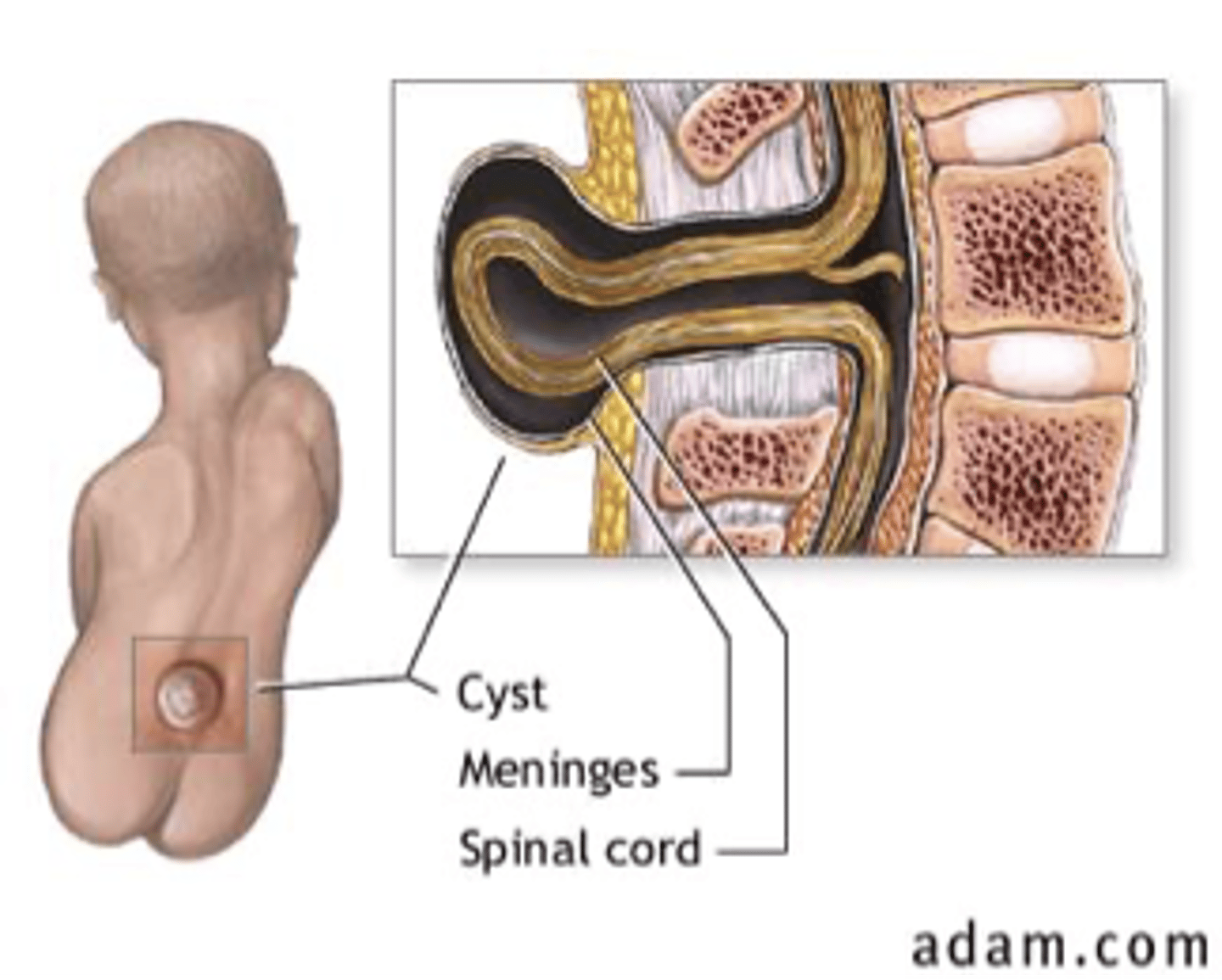 <p>Protrusion of the meninges and nervous tissue</p>