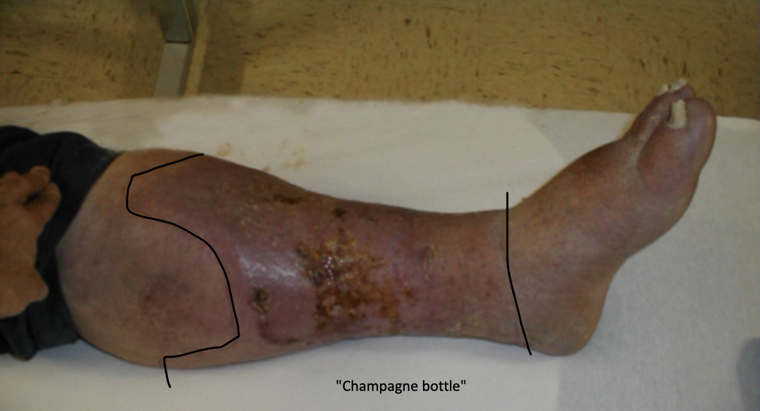 <p>Clinical manifestations of CVI</p>