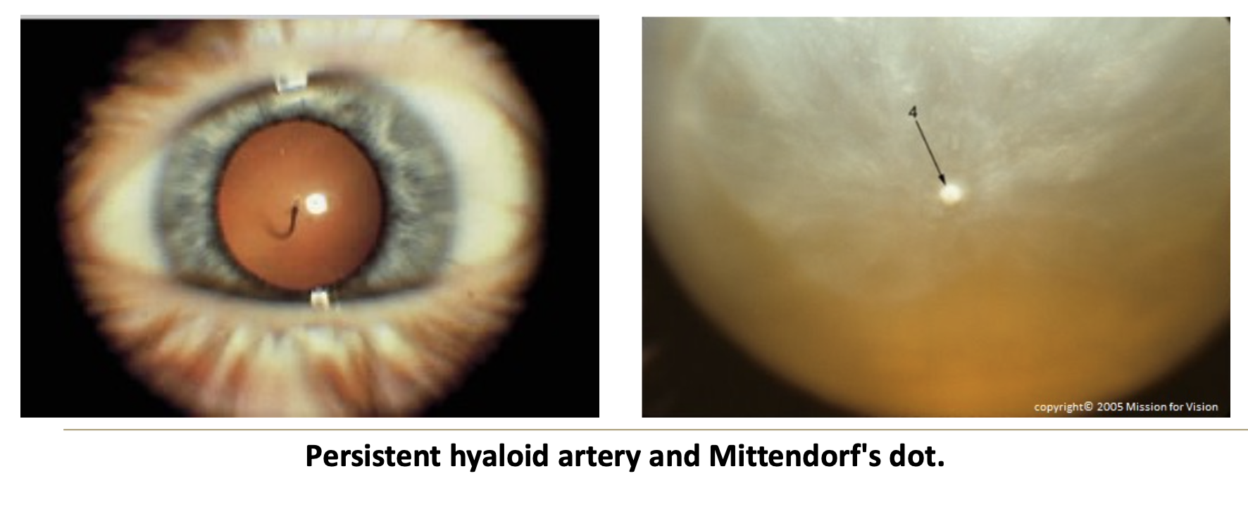 <p>What is a persistent hyaloid artery?</p>
