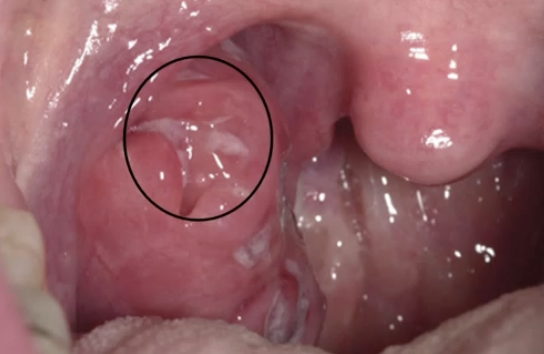 <ul><li><p>Tobacco is NOT the cause</p></li><li><p>Male predilection</p></li><li><p>Adults</p></li><li><p>Increase in sexual partners</p></li><li><p>Location: Oropharyngeal/tonsillar</p></li></ul><p></p>