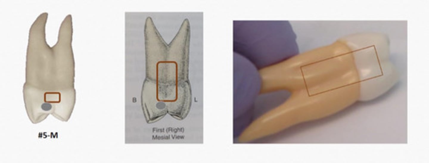 <p>On maxillary first premolar, Mesial root depression in __ with crown depression</p>