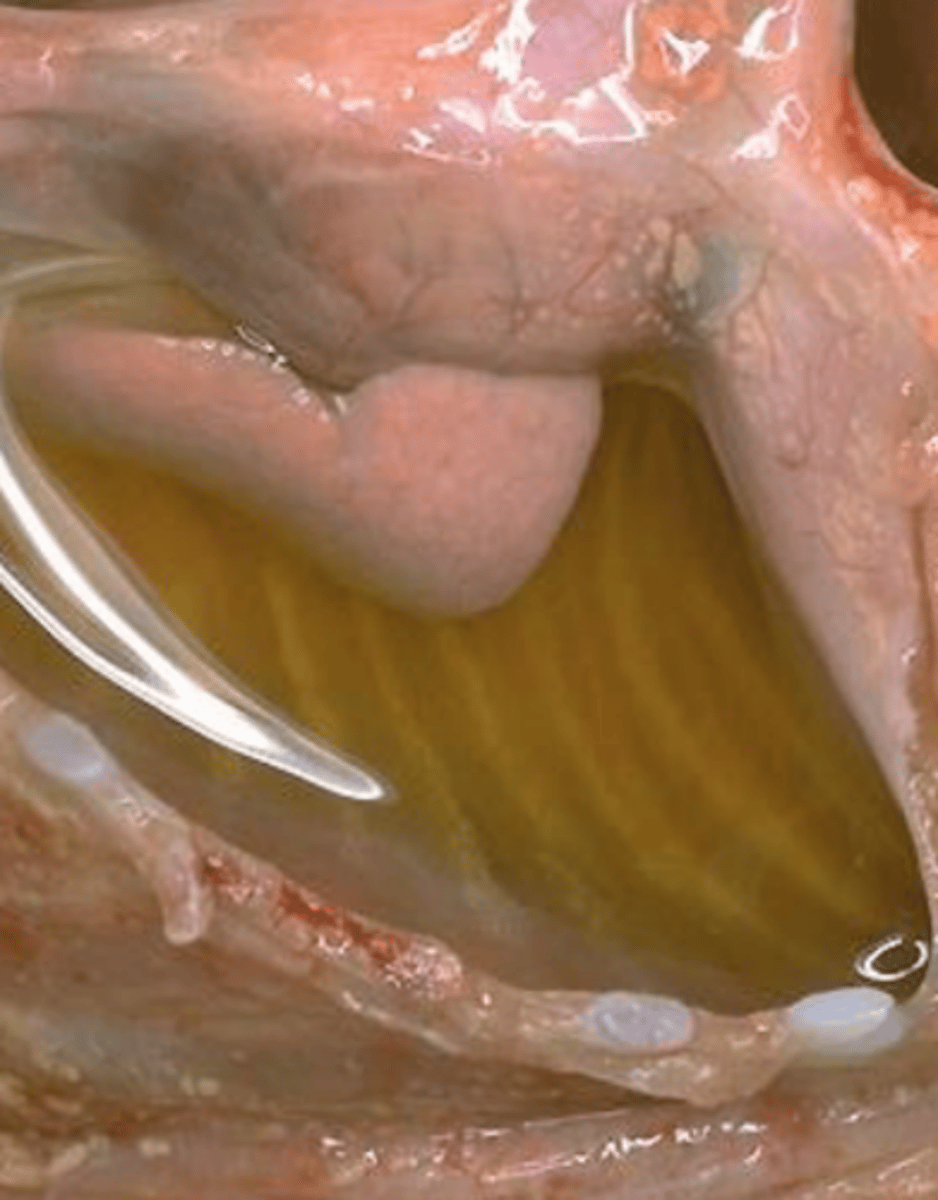 <p>what type of exudate is being depicted in the image?</p>