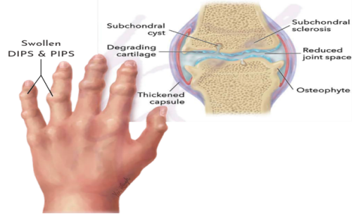 <p>EXPECTED AGE-RELATED CHANGES</p><ul><li><p><span style="color: red;">Deterioration and drying of joint cartilage</span></p></li><li><p>Limited range of motion, joint instability</p></li><li><p>Most common form</p></li><li><p><mark data-color="yellow" style="background-color: yellow; color: inherit;">Not a normal part of aging.</mark></p></li><li><p>The <span style="color: red;">cartilage within a joint begins to break down</span> &amp; the underlying bone begins to change.</p></li></ul><p></p><p>OTHERS:</p><p></p><p>• Death of chondrocytes leads to degeneration of articular cartilage</p><p>• Loss of cartilage leads to eburnation of bone</p><p><span style="color: blue;">• Affects weight bearing joints</span></p><p><span style="color: red;">• Asymmetric (may only affect 1 hand)</span></p><p>• <mark data-color="green" style="background-color: green; color: inherit;">Swelling of DIP and PIP joints </mark>DIP (Distal Interphalangeal) and PIP (Proximal Interphalangeal) are <strong><mark data-color="rgba(0, 0, 0, 0)" style="background-color: rgba(0, 0, 0, 0); color: inherit;">medical terms for two specific joints in each finger</mark></strong></p><p>• Synovial fluid enters bone fractures leading to subchondral cysts</p><p>• Osteophytes form at margins of cartilage</p>