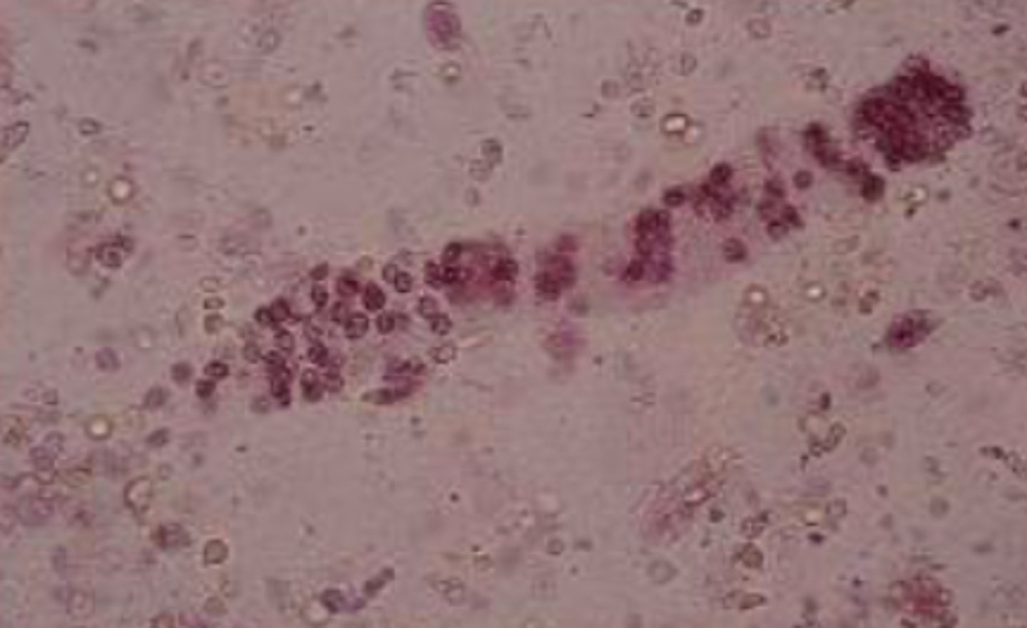 <p>- Appear yellow/orange color</p><p>- Stained - purple/pink color</p><p>- Indicates bleeding in renal tubules</p>