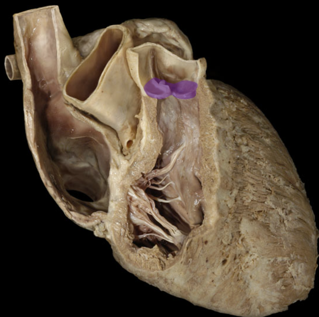 <p>Pulmonary valve</p>
