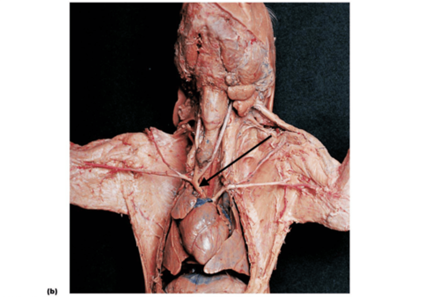 <p>Brachiocephalic artery</p>