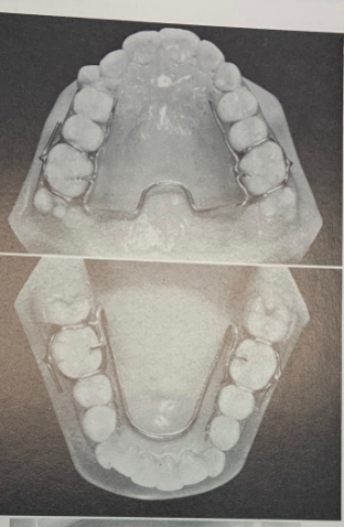 <p>Fixed</p><p>Expands arch</p>