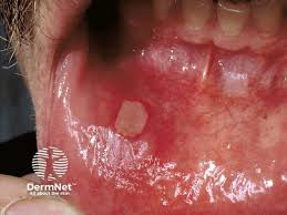 <p>painful</p><p>ulceration</p><p>white center+red halo</p><p>idiopathic</p>