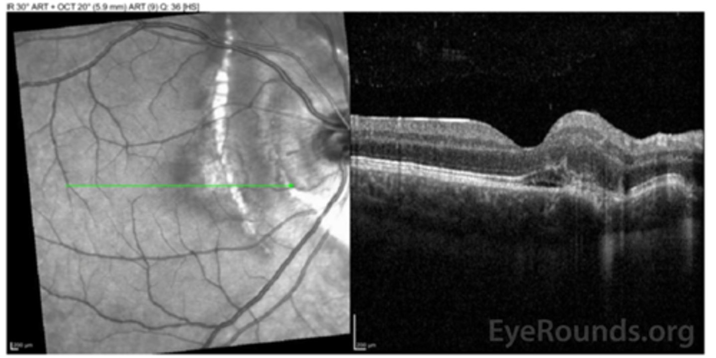 <p>loss of RPE continuity at site of rupture = inner choroid atrophy</p>