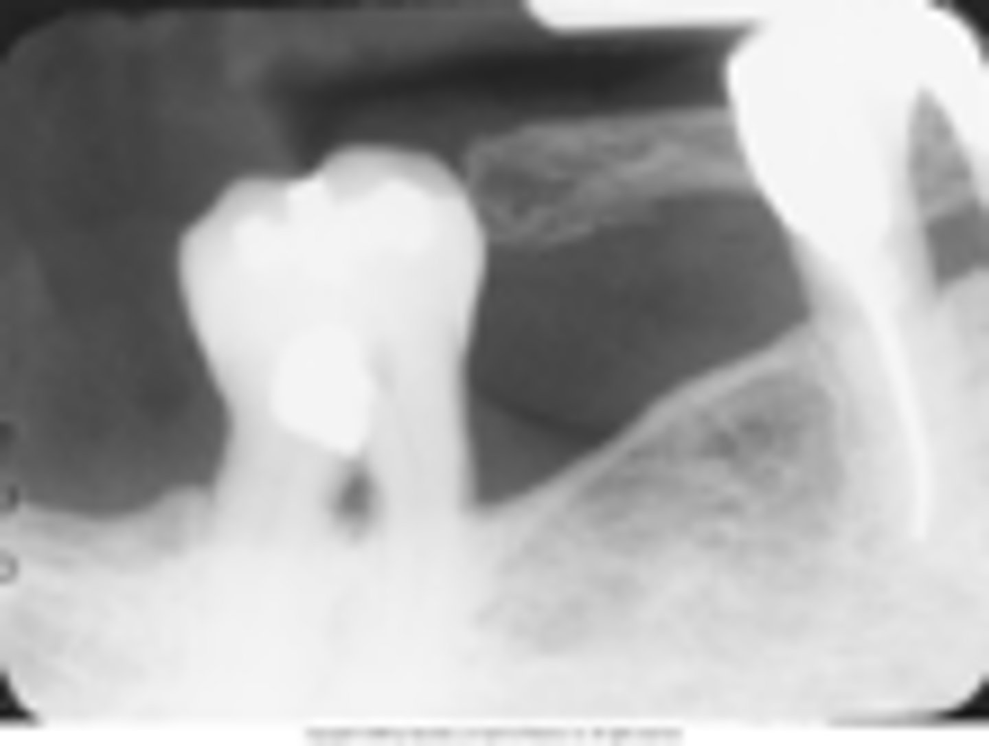 <p>Distal phalanx of the finger is seen in the radiograph</p>