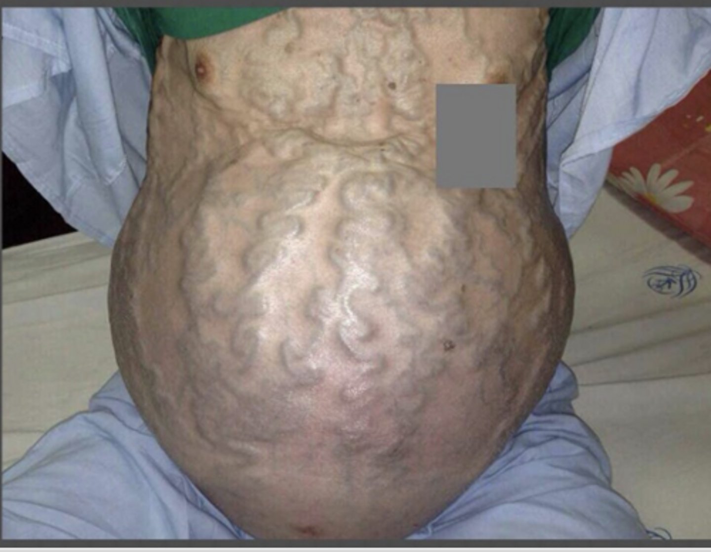 <p>Caput medusa (secondary to liver failure)</p>